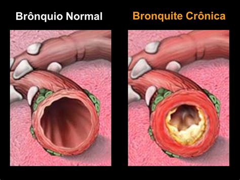 bronquite cronica